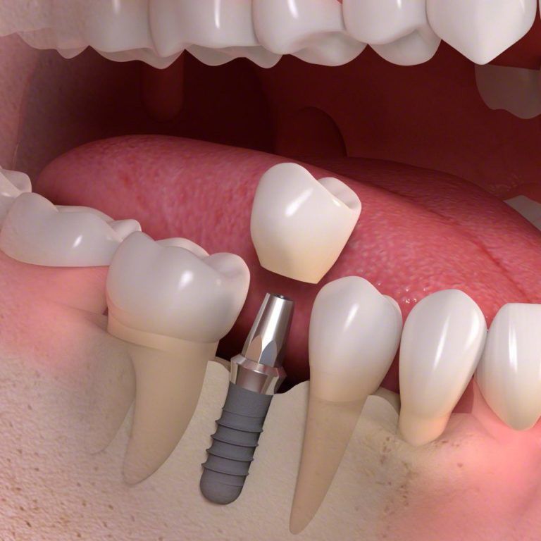 Implants vs. Bridges » New York, NY Dentistry - Delaire Dental